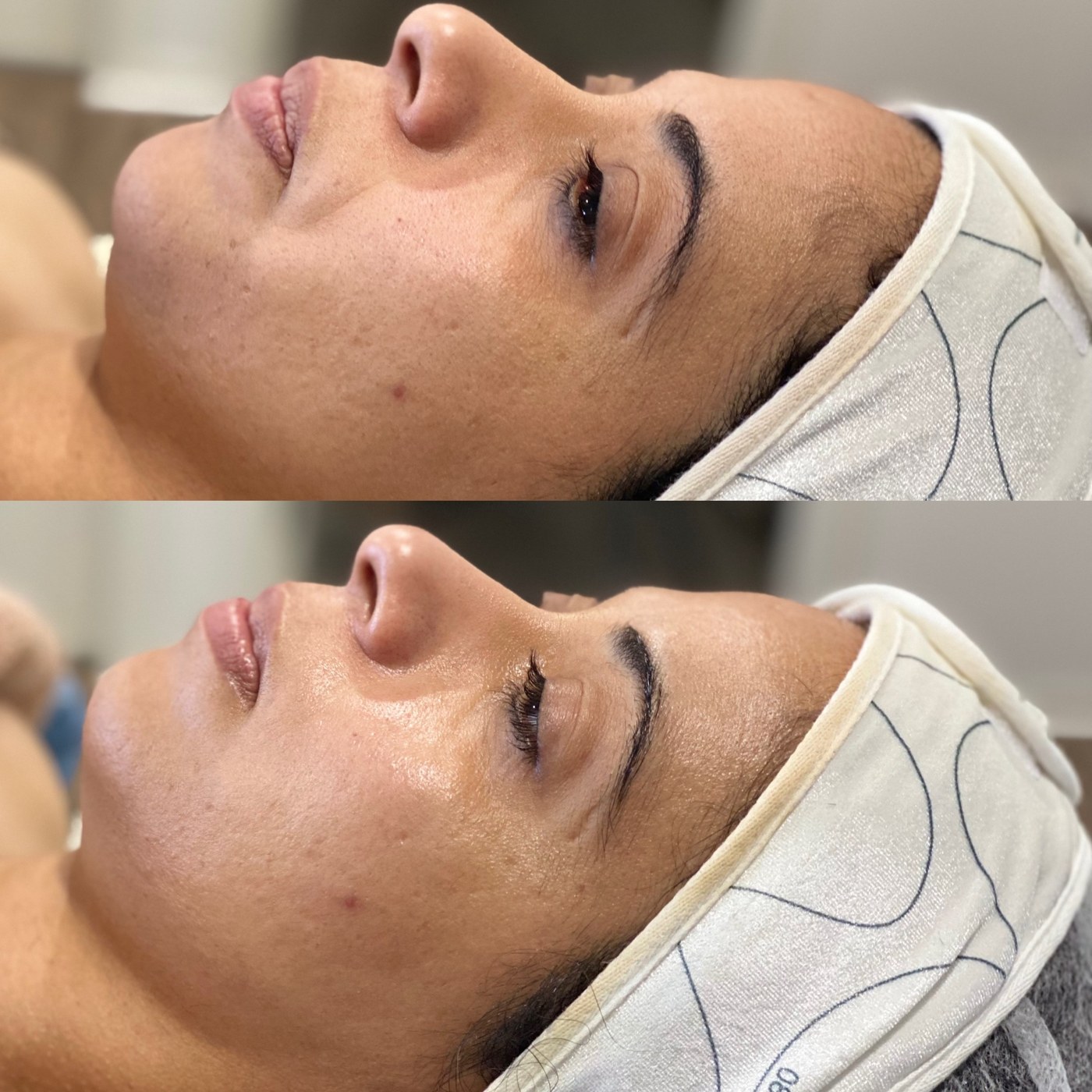Before and after skin treatment at Salon Esvees
