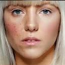 acne facial treament cranbourne